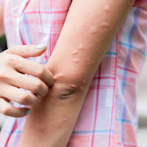 someone with mosquito bites